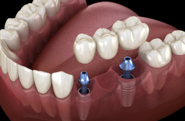 Dental Implants Image 1