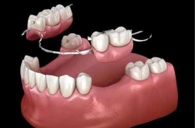 Dental Implants Image 1