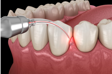 Dental Implants Image 1