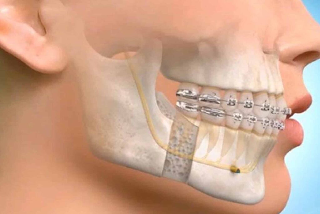Dental Implants Image 1