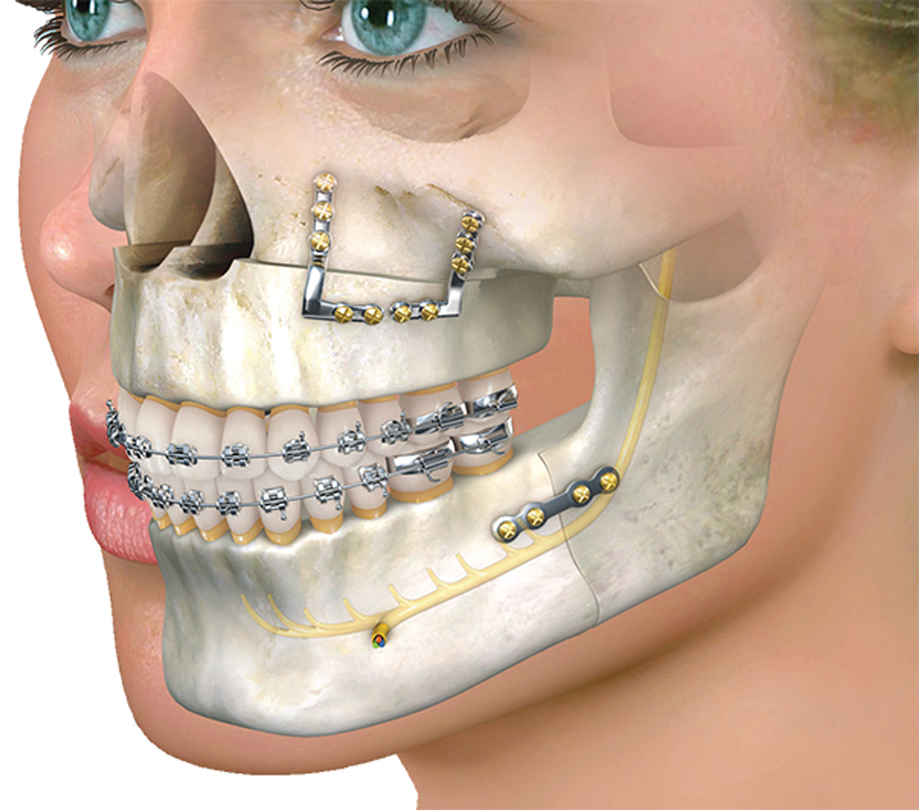 Dental Implants Image 1
