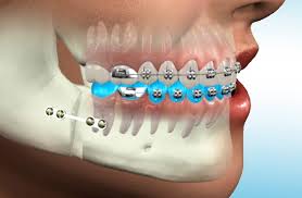 Dental Implants Image 2