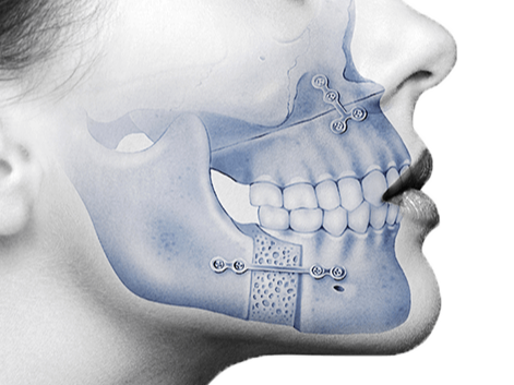 Dental Implants Image 3