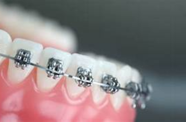 Dental Implants Image 1